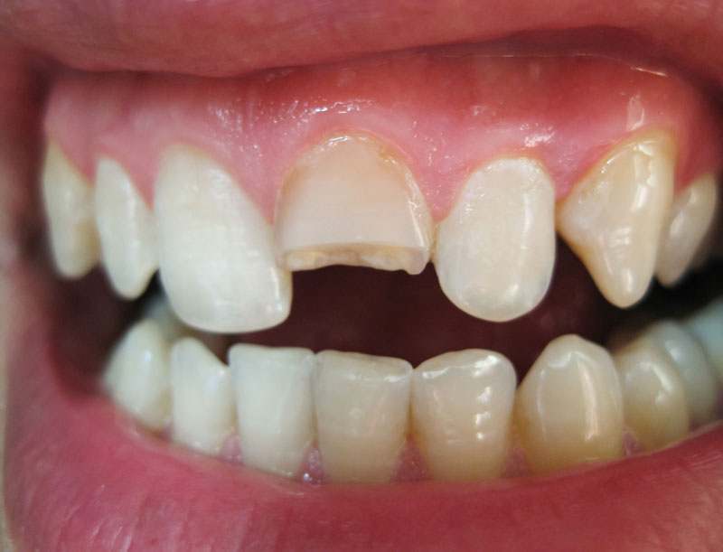 Dental Emergency- Tooth Pain